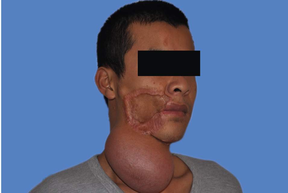 如何使用皮肤扩张术治疗大面积面部瘢痕?