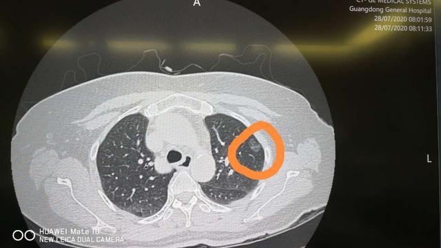 體檢發現肺部磨玻璃結節不必焦慮建議找有經驗的胸外科醫生隨訪或者