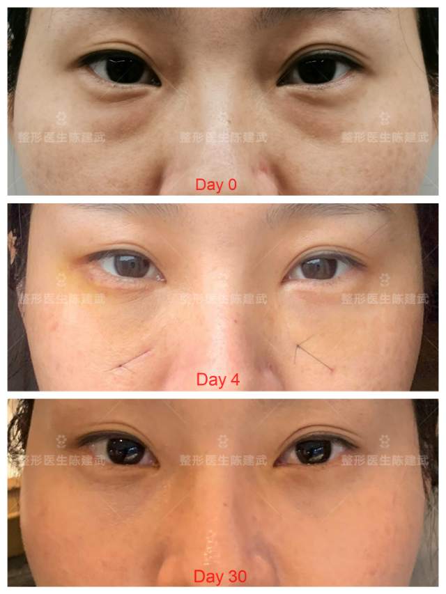 内切眶隔脂肪释放后30天效果案例138