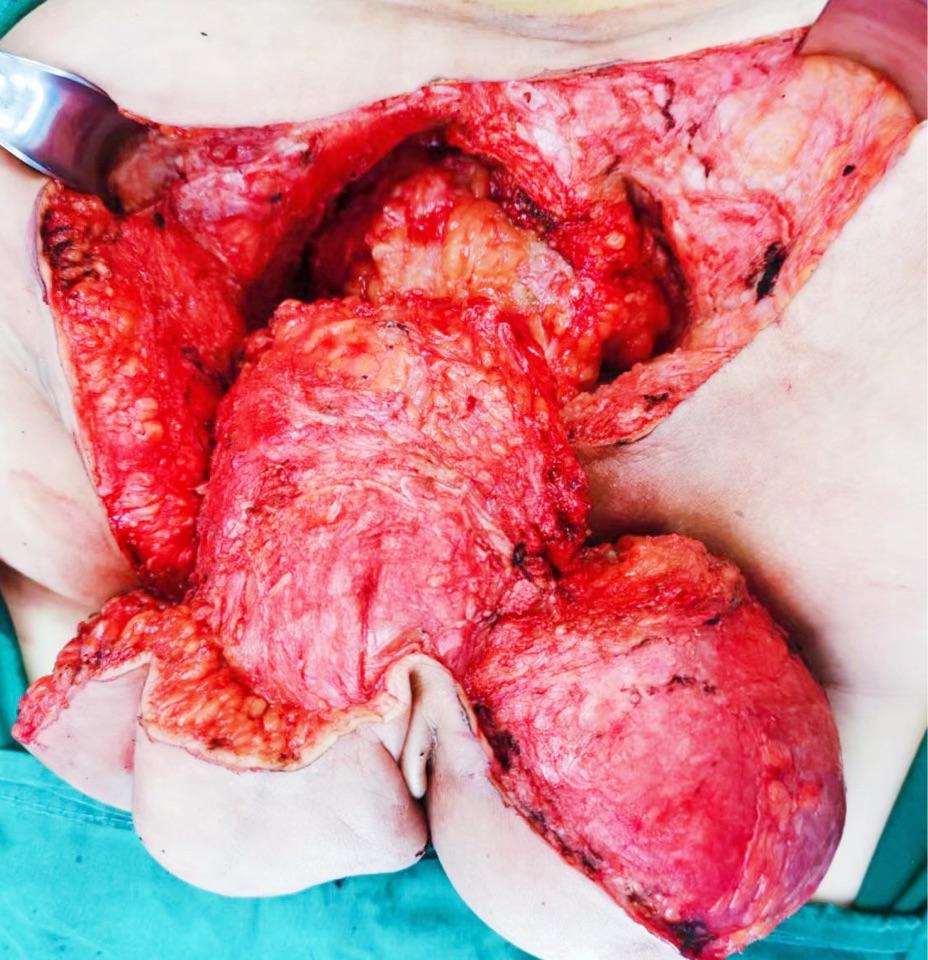 多发巨大表皮样囊肿一例,完美手术 - 微医(挂号网)