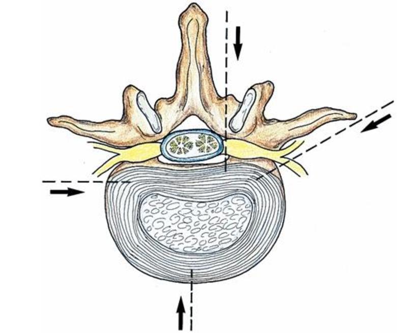 什么是腰椎侧路椎间孔镜技术和腰椎后路内镜技术?我应该如何选择?