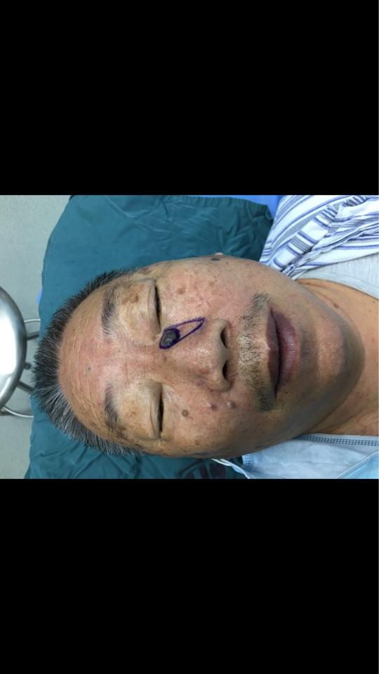 面部皮肤肿瘤风筝皮瓣修复 - 微医(挂号网)
