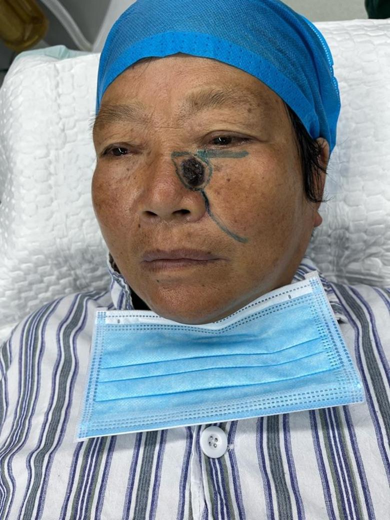 鼻背基底细胞癌扩切皮瓣修复