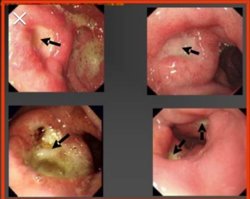 胃镜发现胃溃疡时需要取活检明确溃疡的良恶性,内镜下的表现也可以