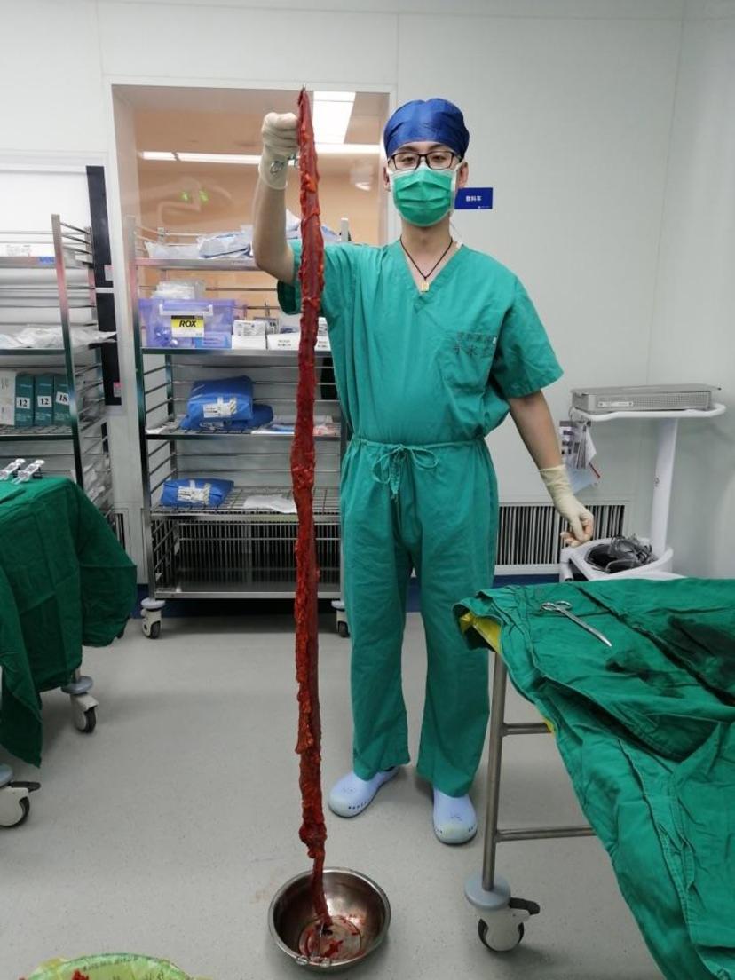 8月14日全麻下行腹腔镜全结肠切除术 直肠前突经肛修补术,手术切除