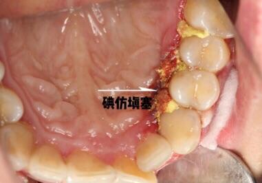 牙龈瘤微创摘除3例