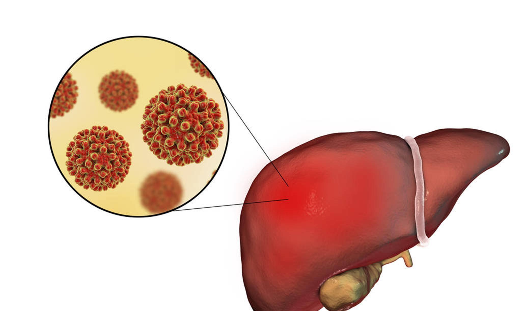 乙肝图片高清图片