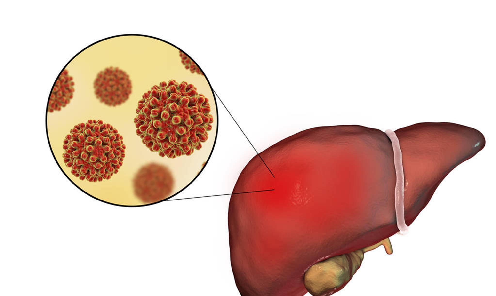 乙肝病毒需要一辈子吃药吗