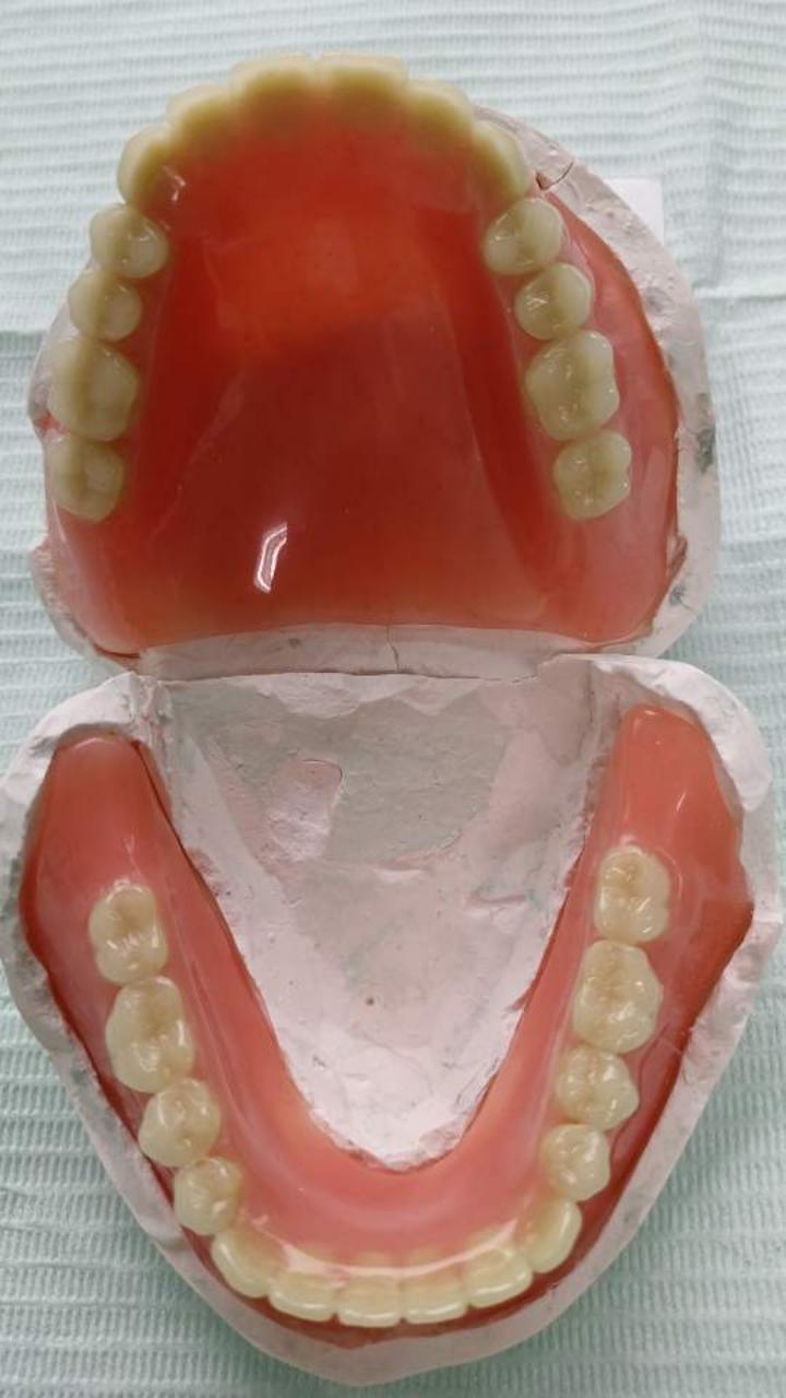 牙列缺失的修复方式——吸附力义齿_赵运流医生文章_重庆医科大学附属