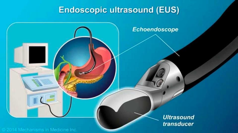 内镜技术巡礼之超声内镜