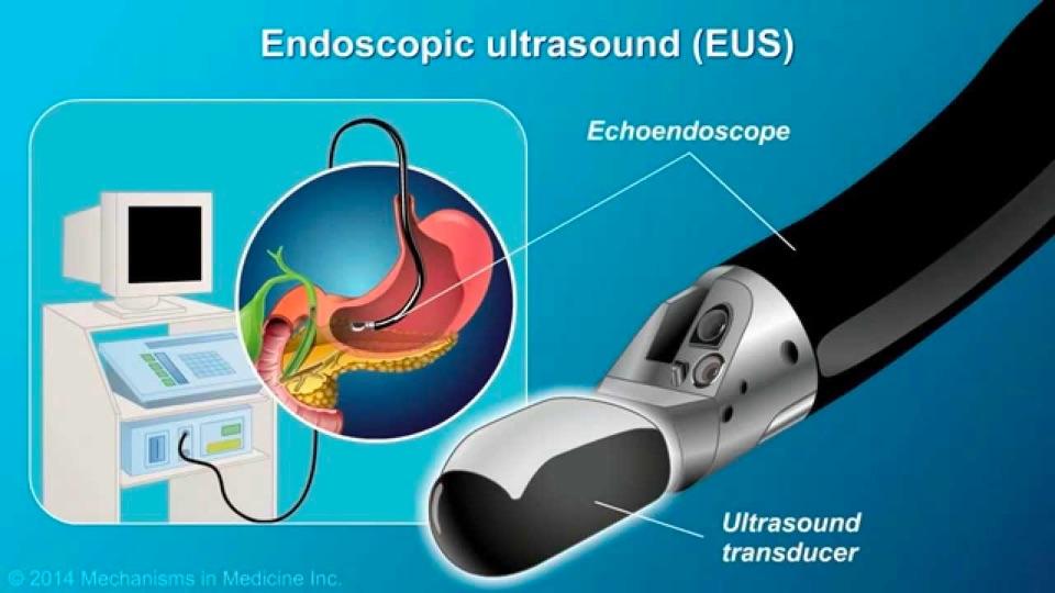 內鏡技術巡禮之超聲內鏡