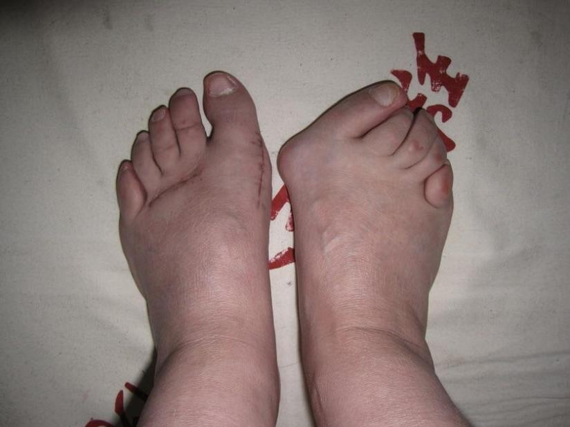 踇外翻 对女性造成困扰最大的足部畸形 健康号 微医