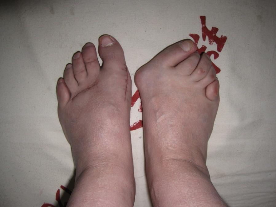 踇外翻——对女性造成困扰最大的足部畸形