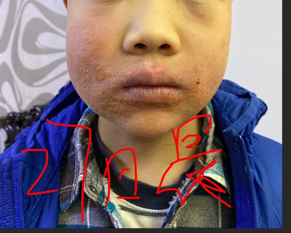 脸部莫名肿大 脸部比头还大,淋巴结也肿大,脸部还出水