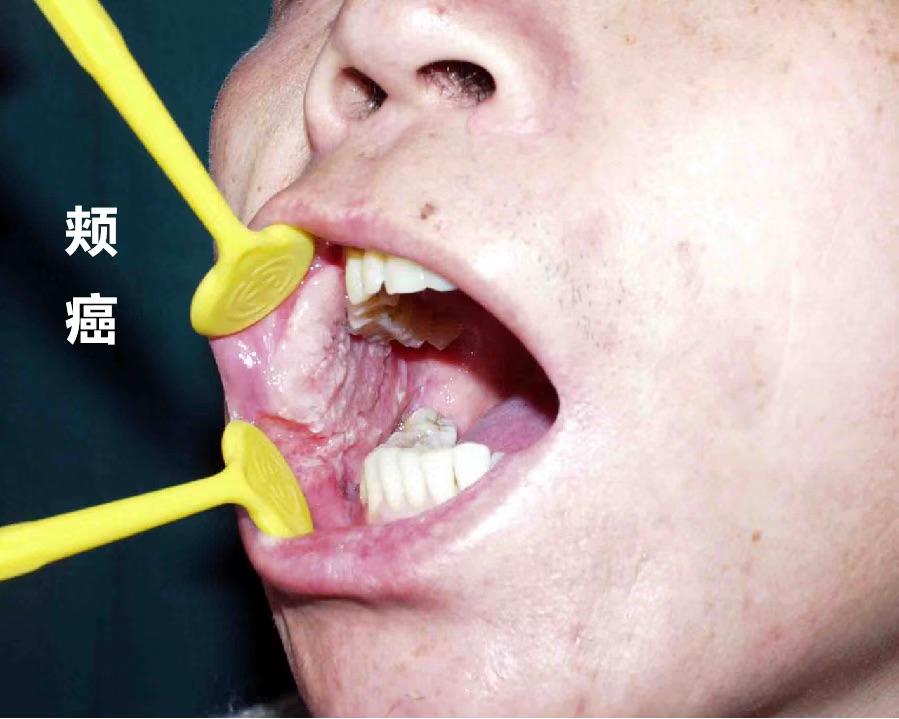 口腔癌的防治_健康号-微医