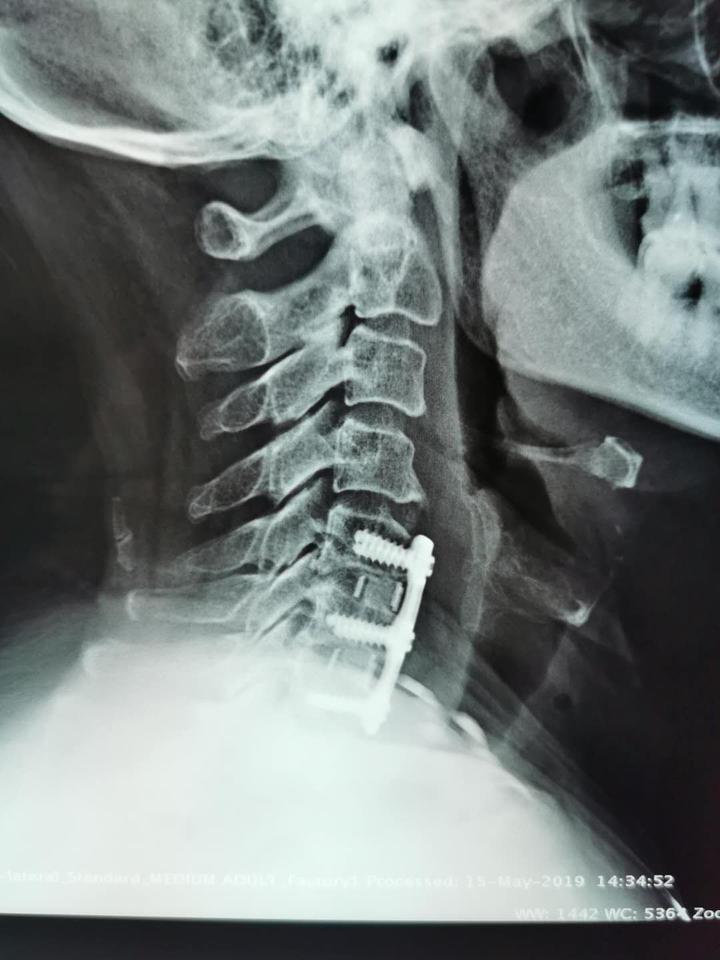 颈椎零切迹固定融合器械效果和普通钢板固定效果差不多