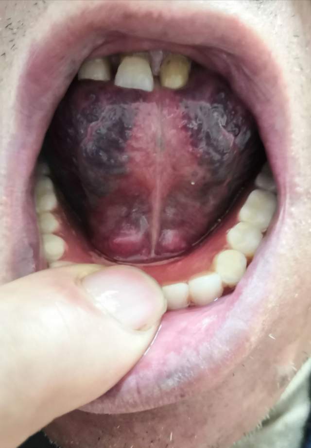 典型的舌下络脉迂曲