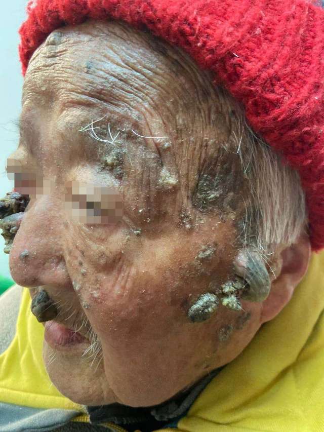 皮角不可怕,关键在于早治疗