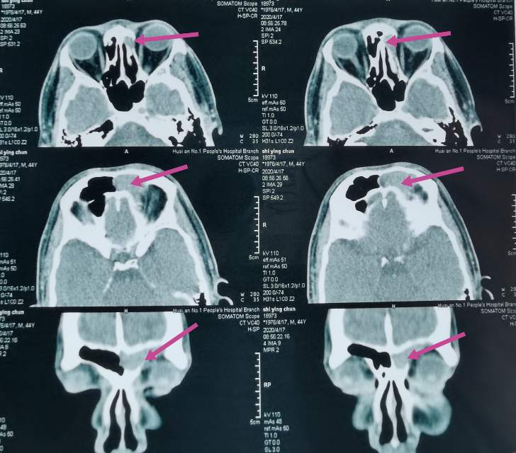 病案纪实额窦炎