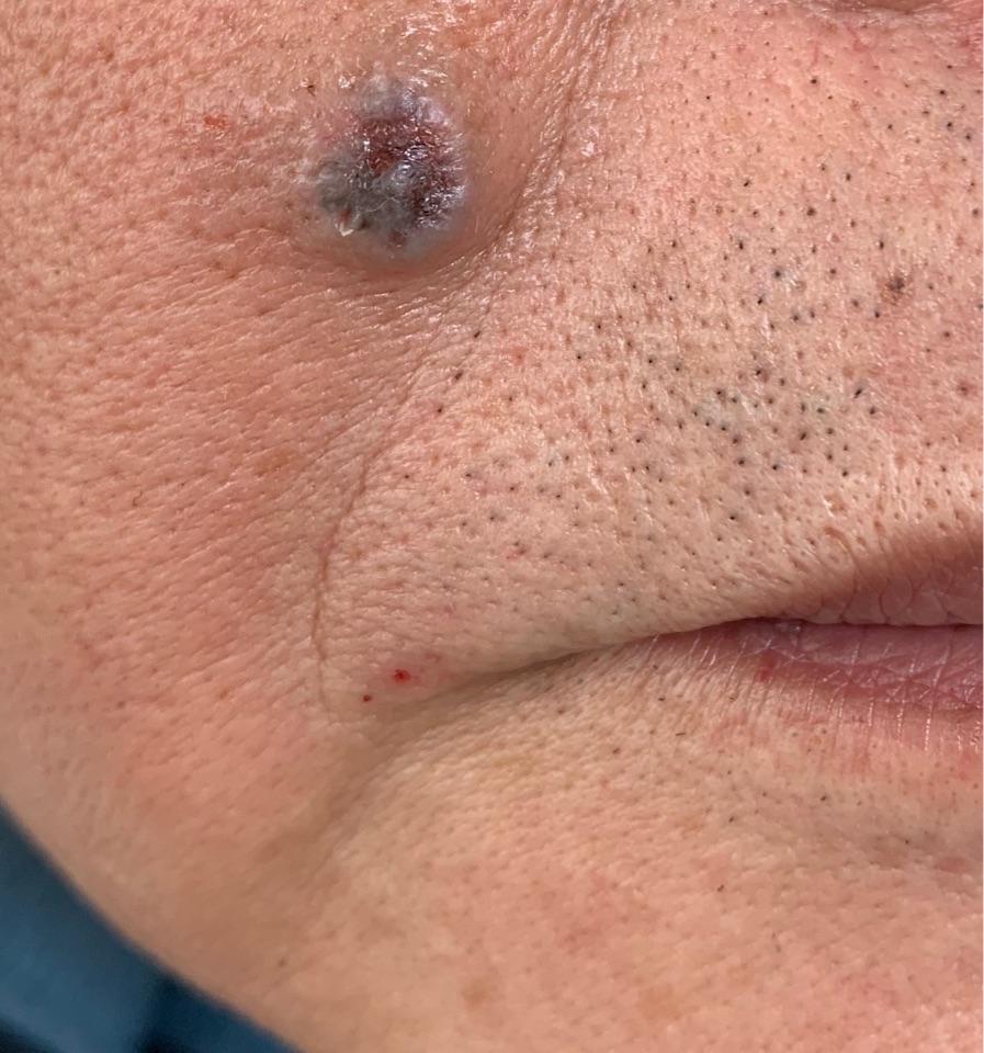 身上的痣到底需不需要手术?