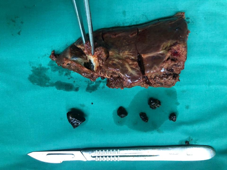 微创腹腔镜胆总管切开取石 结石肝段切除治疗肝内外胆管结石