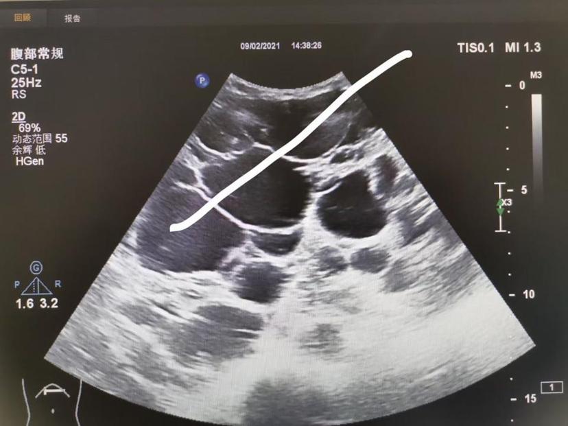 超声引导多囊肝抽液硬化治疗