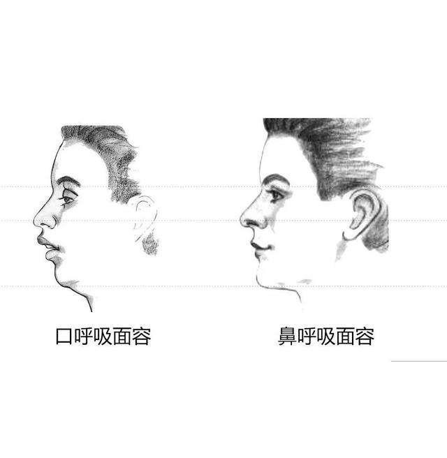 口呼吸:在生長發育期,長期口呼吸會發展成腺樣體樣貌,不僅會導致下巴