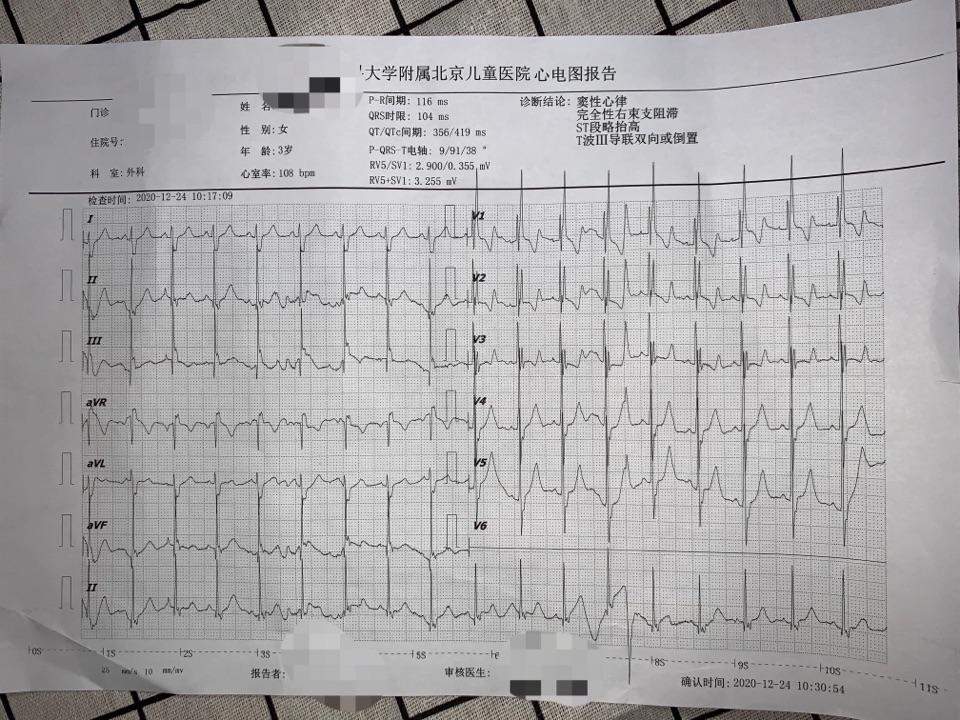 第二个问题,如果报告中出现完全右束支传导阻滞,或或者不完全右束支