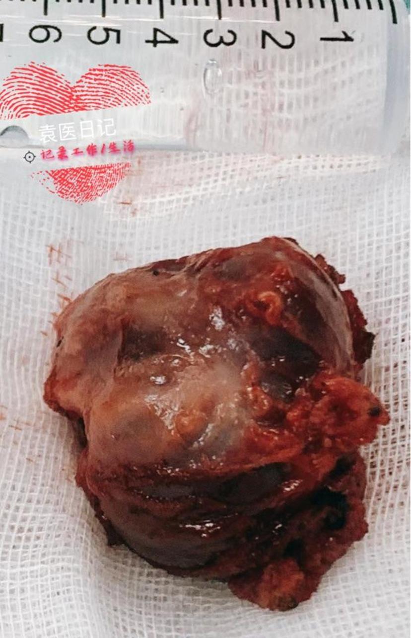 由于囊肿及瘘管同舌骨体的密切关系,手术时应切除与之相连的舌骨体中