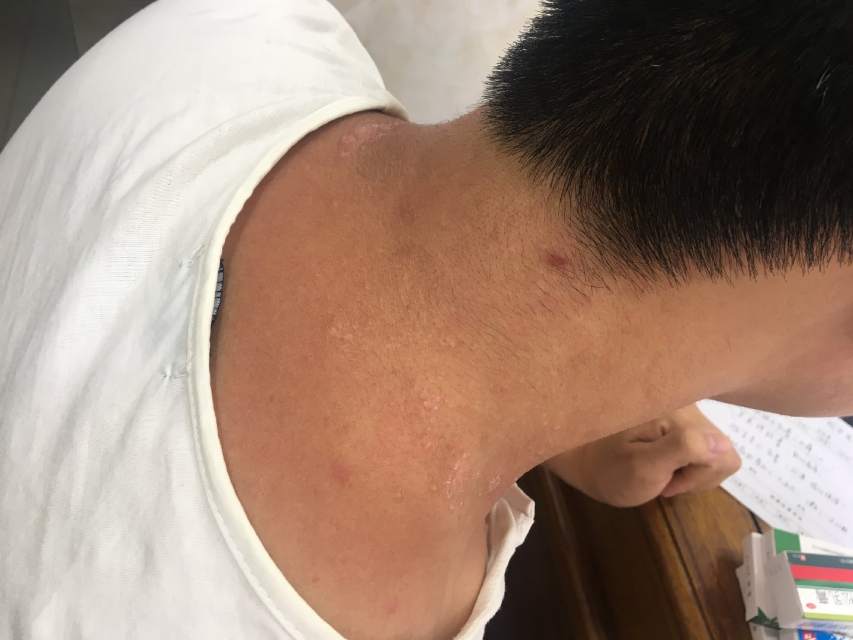 慢性日光性皮炎患者,男,36岁,自诉3年前开始不明原因接触阳光后,后颈