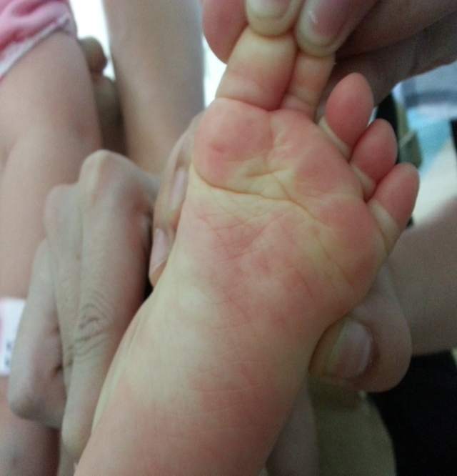 带你认识儿童川崎病