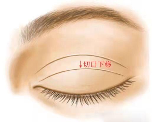 过宽的双眼皮修复就是单纯的宽改窄吗