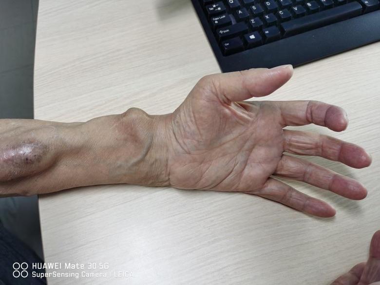 爪形手在糖尿病周围神经病变里面到底常见不常见