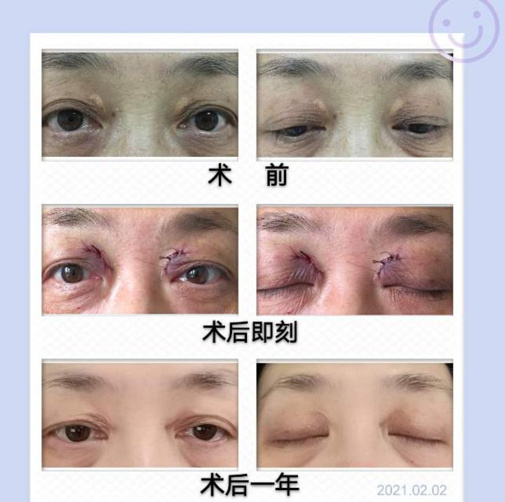 激光治疗的经过,但复发并且生长更快,通过美容设计手术方案,切除黄色