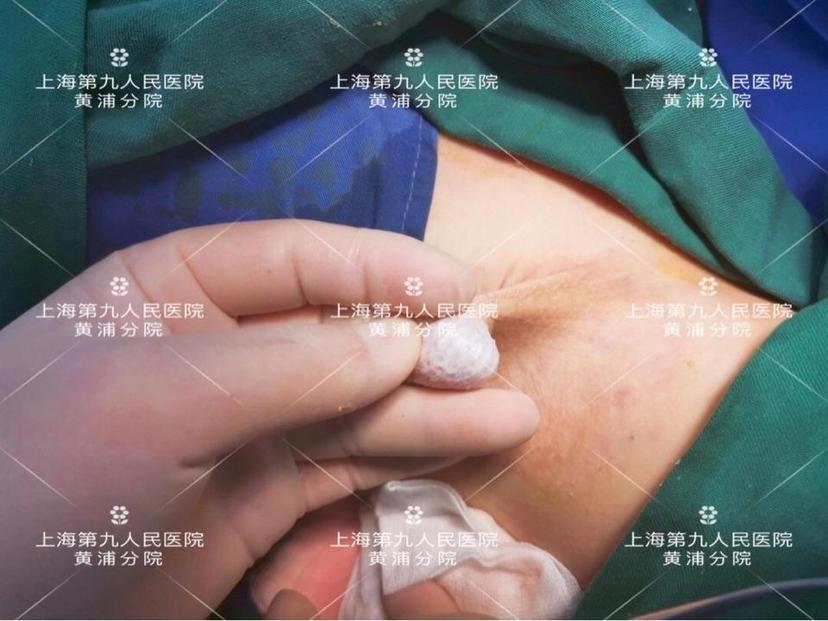 为什么翻转皮瓣手术是一个能根治腋臭的手术因此真正切除下来的是汗腺