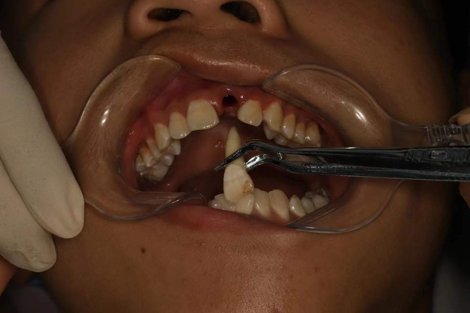 年轻恒牙嵌入性脱位图片