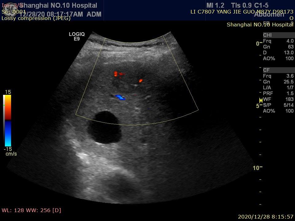 超声引导原发性肝癌射频消融术