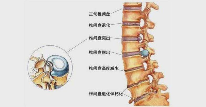 腰椎間盤突出組圖:腰椎骨折組圖(分別是壓縮性骨折示意圖,骨質疏鬆