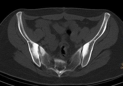 03产后腰痛小心致密性骨炎