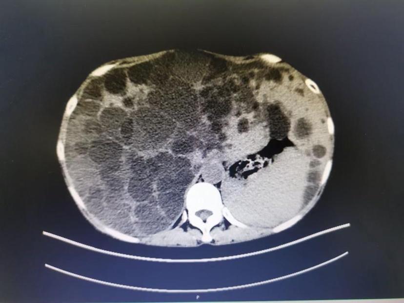 超声引导多囊肝抽液硬化治疗