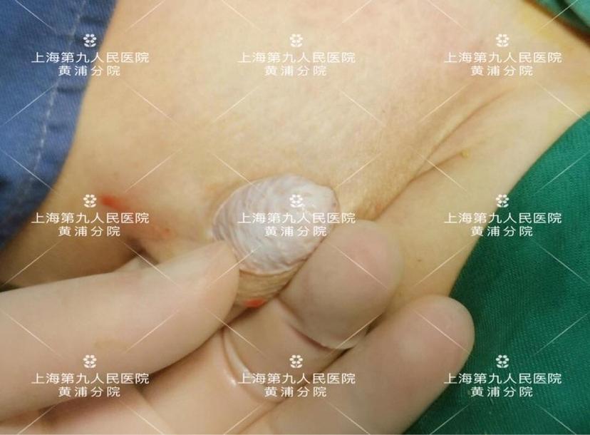 腋臭手术到底切掉了什么狐臭