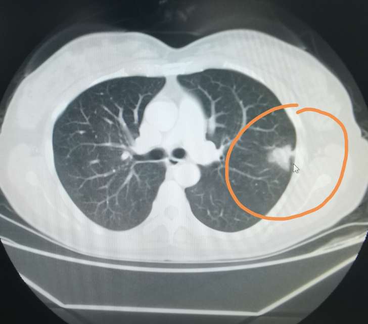 肺部肿瘤胸片图片