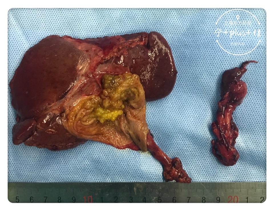 胆囊癌恶性程度极高,即使早期发现早期手术,仍不能保证根治.