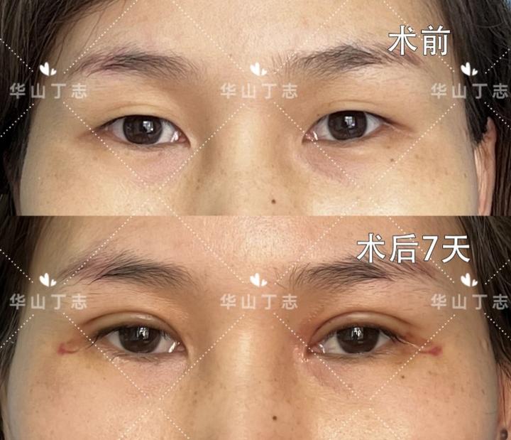 【上眼皮松弛&bull;全切双眼皮术后7天】 - 微医(挂号网)