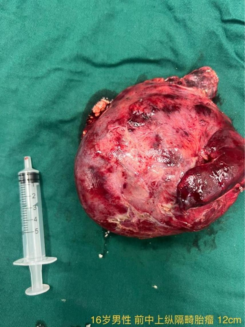 微创巨大纵隔肿瘤切除