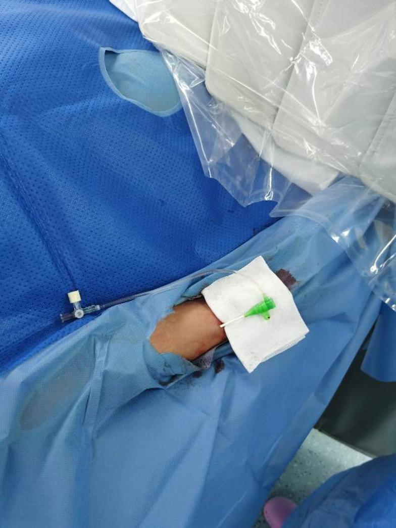 冠状动脉造影球囊扩张术支架植入术