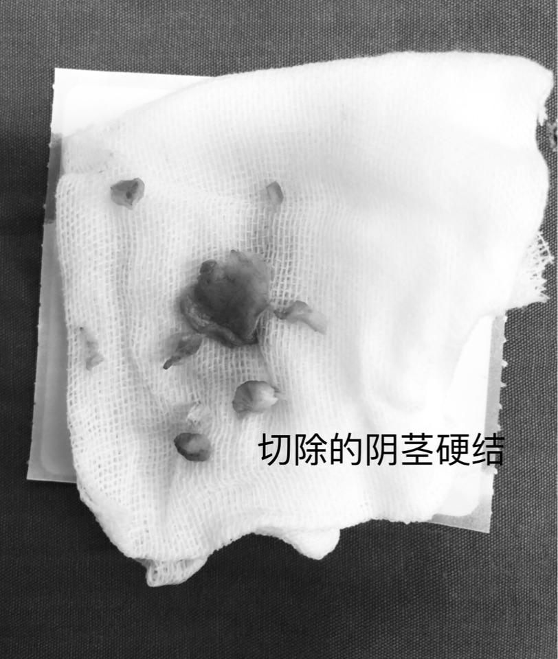 手术工作日志15怎样预防阴茎硬结症阴茎硬结切除阴茎弯曲矫正手术治疗