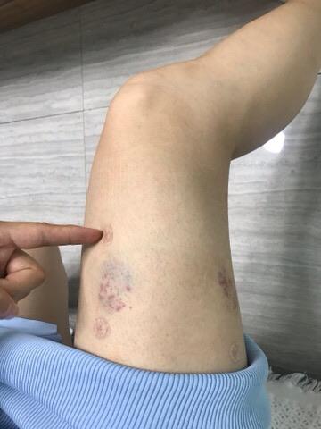 17位病患寻求股外侧皮神经炎的治疗方法