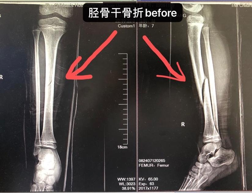 骨折的复位很容易 牢靠的固定很重要 健康号 微医
