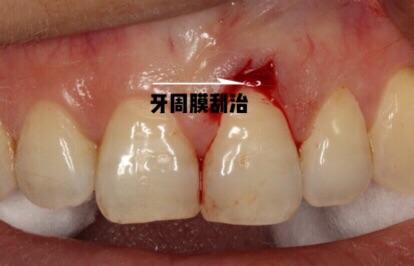 牙龈瘤微创摘除3例